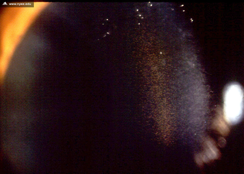 Krukenberg's Spindle in PDS NYEE